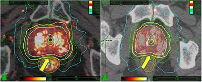 Frontiers | Prostate SBRT: Comparison The Efficacy And Toxicity Of Two ...